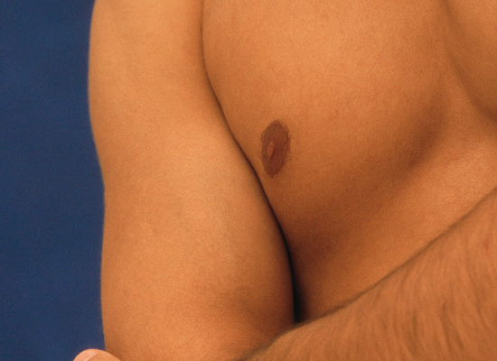 Ginecomasty Or Male Breast Reduction